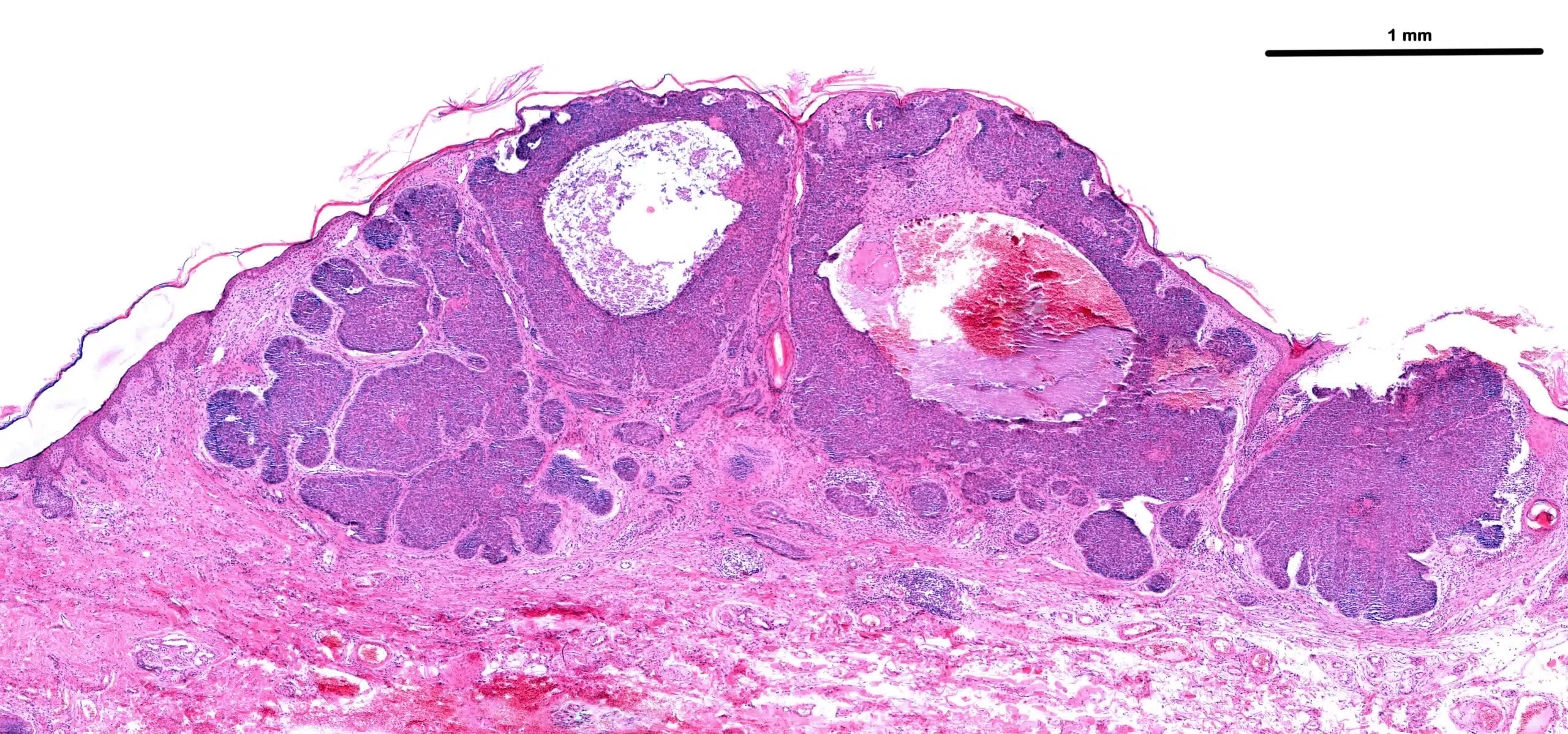 Large,Basal,Cell,Carcinoma.,Cords,And,Large,Islands,Of,Basophilic